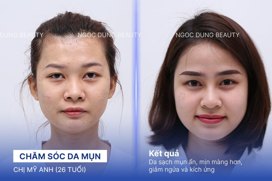Chăm sóc da mụn – 8 buổi – Giảm ngứa và kích ứng