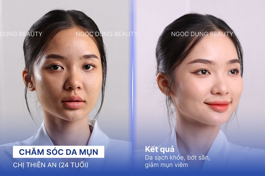 Chăm sóc da mụn – 4 buổi – Giảm mụn ẩn gây ngứa