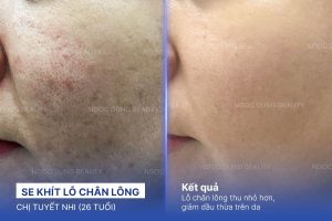 Chị Tuyết Nhi (26 tuổi) - Se Khít Lỗ Chân Lông