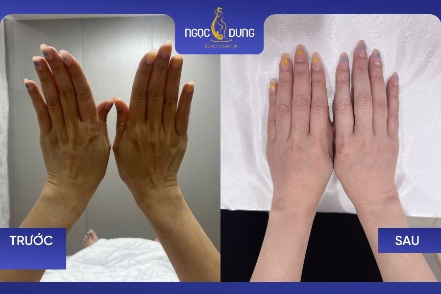Kết quả làm trắng da tay tại TMV Ngọc Dung