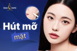 hút mỡ mặt