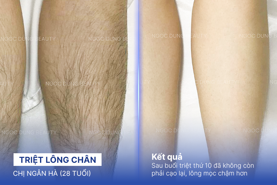 Triệt lông chân – 10 buổi – Da chân đều màu láng mịn