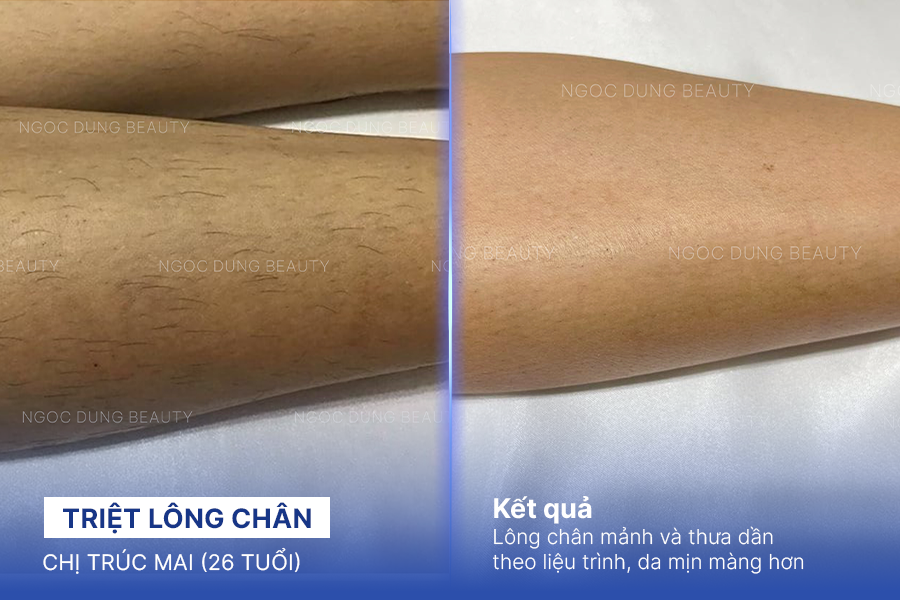 Triệt lông chân – 7 buổi – Sạch lông chân an toàn