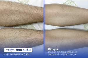Triệt lông chân – 9 buổi – Da chân sáng mịn mướt