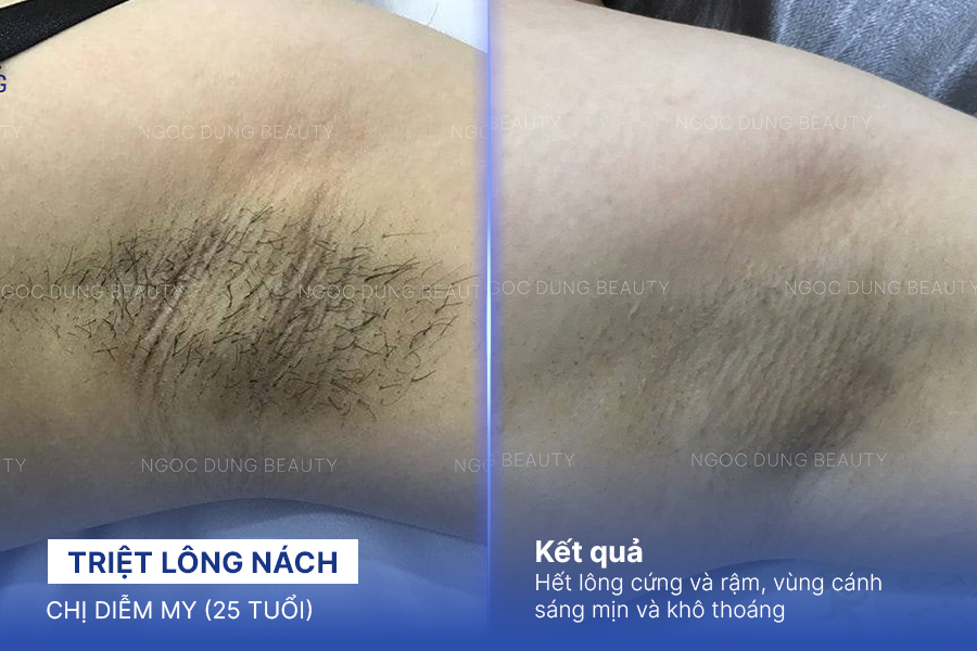 Triệt lông nách – 10 buổi – Giảm mùi vùng cánh