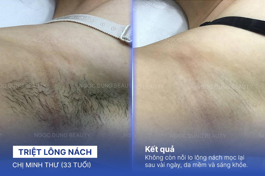 Triệt lông nách – 12 buổi – Nách sạch lông giảm thâm