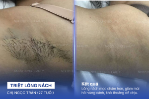 Triệt lông nách – 4 buổi – Vùng cánh sáng màu rõ rệt