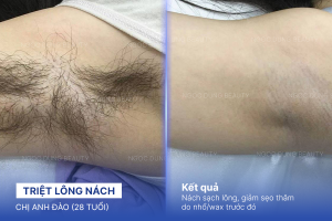 Triệt lông nách – 8 buổi – Giảm mùi cơ thể