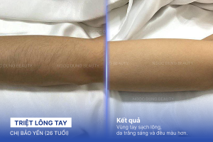Triệt lông tay – 10 buổi – Tự tin diện áo ngắn tay