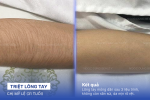 Triệt lông tay – 8 buổi – Da tay mịn màng sáng khỏe