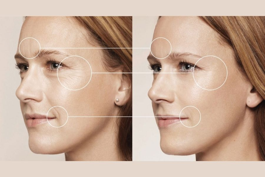 HIFU là một trong những công nghệ nâng cơ trẻ hóa da hiện đại