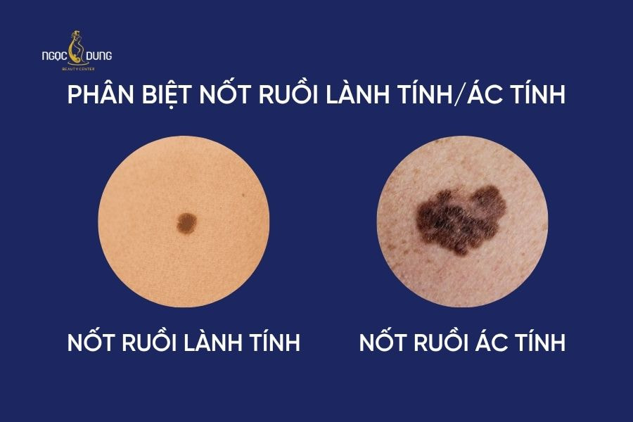 Việc hiểu rõ sự khác biệt giữa hai loại nốt ruồi giúp tăng cơ hội điều trị thành công và phòng tránh biến chứng nguy hiểm cho sức khỏe