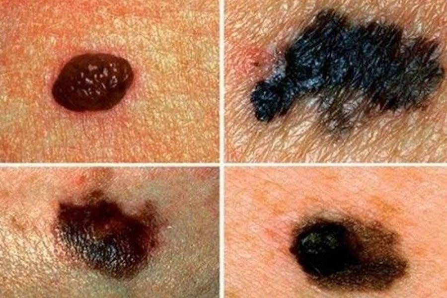 Một số hình dạng của nốt ruồi ác tính