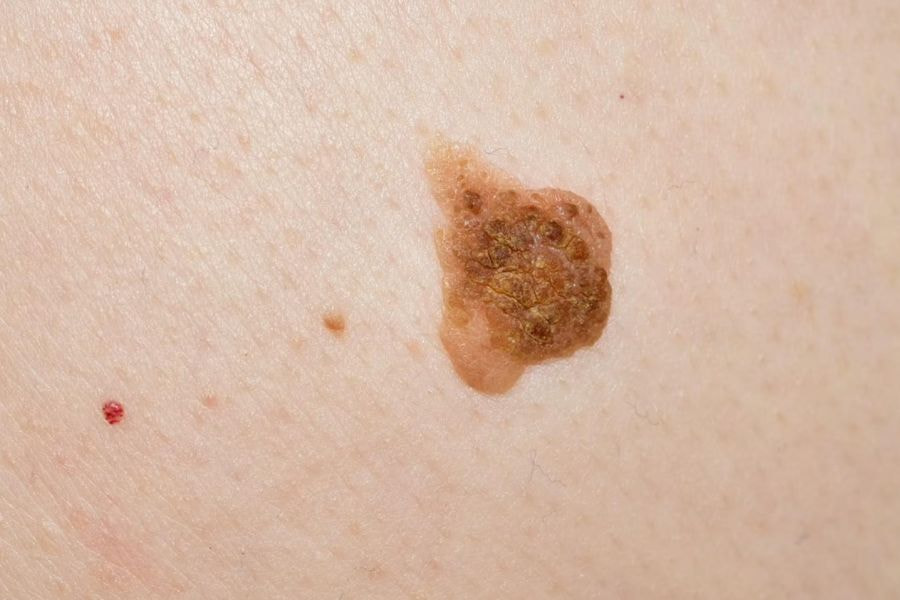 Nốt ruồi ở bàn chân mang ý nghĩa gì và cách tẩy an toàn 9 Nốt ruồi có hình dáng kì lạ thường là cảnh báo về vấn đề sức khỏe