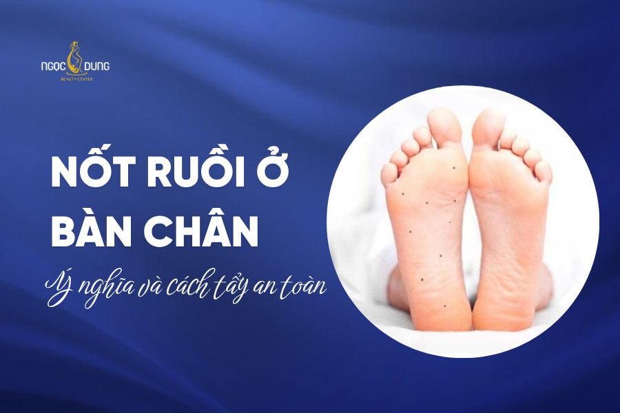 Nốt ruồi ở bàn chân