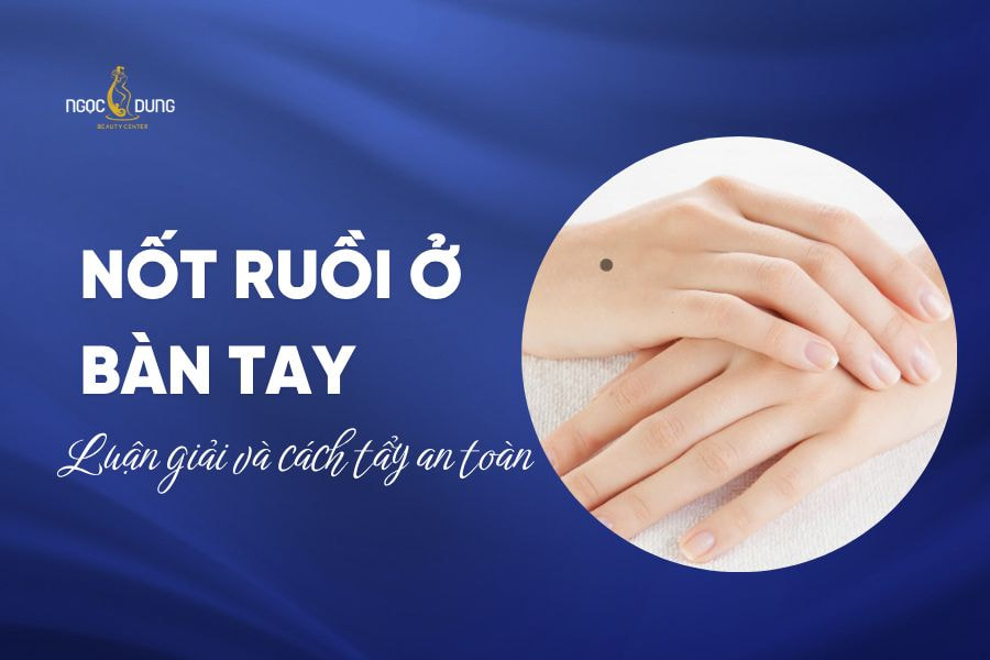 nốt ruồi ở bàn tay