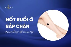 nốt ruồi ở bắp chân