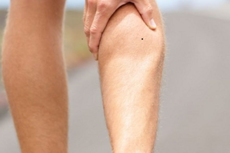 Nốt ruồi ở bắp chân là hiện tượng da liễu bình  thường ở cơ thể 