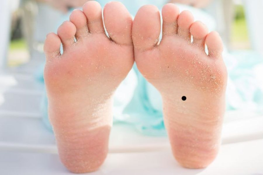 Nốt ruồi ở bàn chân mang ý nghĩa gì và cách tẩy an toàn 8 not ruoi o chan trai nu