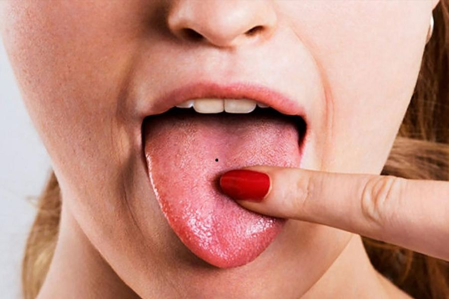 Nốt ruồi ở giữa lưỡi