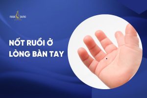 nốt ruồi ở lòng bàn tay