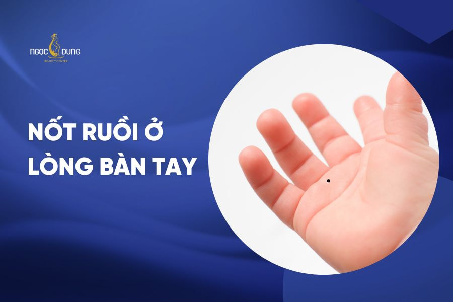 nốt ruồi ở lòng bàn tay