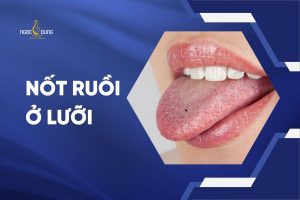 Nốt ruồi ở lưỡi tốt hay xấu và có nên tẩy hay không?