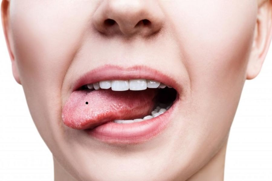 Nốt ruồi ở lưỡi là một hiện tượng sinh lý hiếm gặp