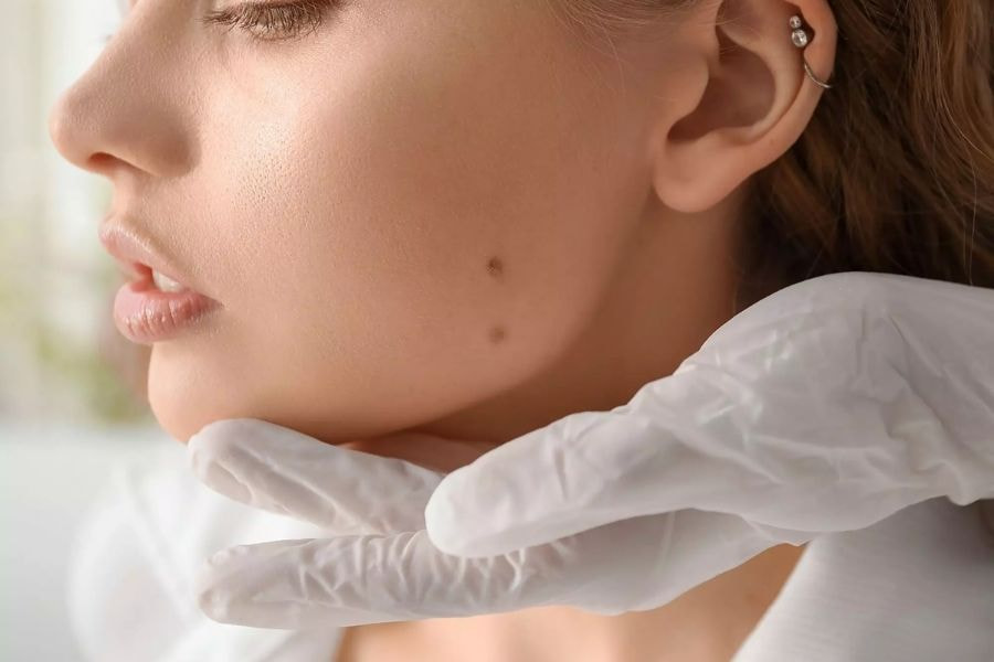 Nốt ruồi trên mặt có ý nghĩa gì? Bật mí điều ít ai biết 2 Di truyền và tiếp xúc với tia UV trong thời gian dài thường là yếu tố làm tăng nguy cơ xuất hiện nốt ruồi trên mặt