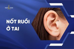 nốt ruồi ở tai