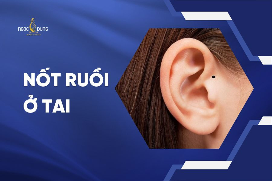 nốt ruồi ở tai