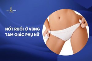 nốt ruồi ở vùng tam giác phụ nữ