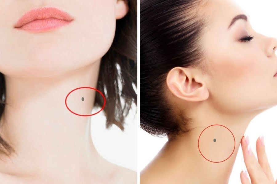 Phân loại nốt ruồi  là cơ sở để quyết định việc có nên loại bỏ hay không, đặc biệt với các nốt ruồi có dấu hiệu bất thường