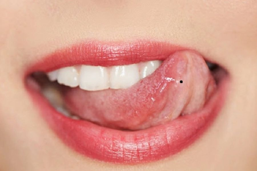 Việc phát hiện sớm nốt ruồi ác tính sẽ nâng cao khả năng điều trị thành công 