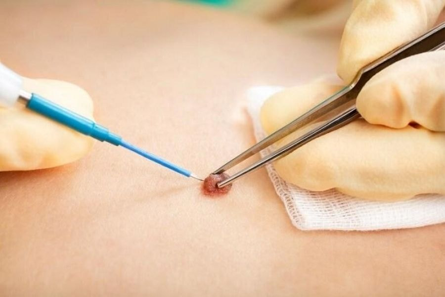 Nốt ruồi ở cánh tay nói lên điều gì về tính cách bạn? 9 Việc quyết định phẫu thuật nên dựa trên chỉ định của bác sĩ chuyên khoa, tránh tự ý thực hiện tại các cơ sở không được cấp phép