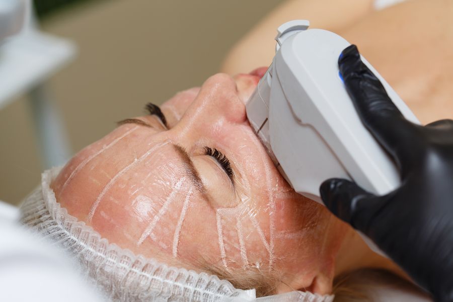 Công nghệ Điêu khắc 10 đường line là gì