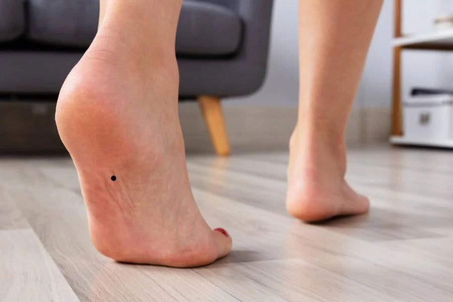 Nốt ruồi ở bàn chân mang ý nghĩa gì và cách tẩy an toàn 3 Mỗi vị trí nốt ruồi trên bàn chân mang ý nghĩa nhân tướng học khác nhau