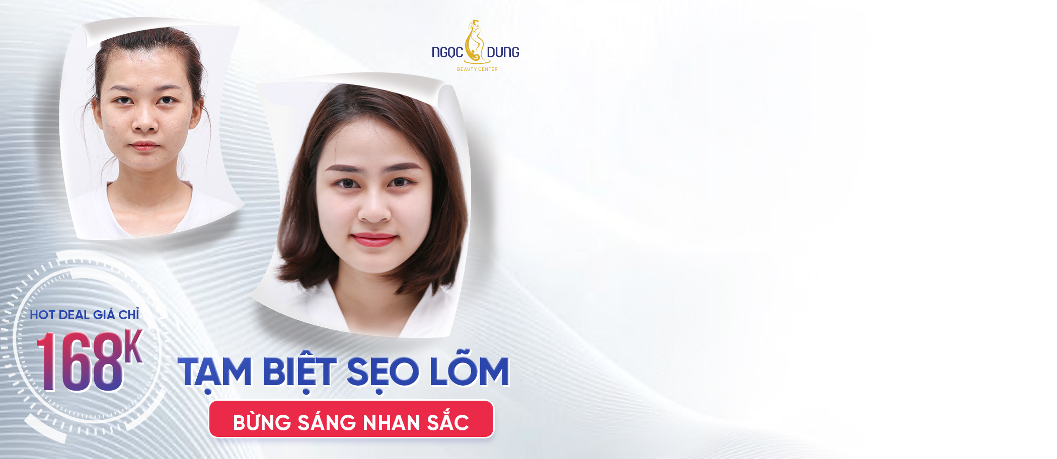 ưu đãi trị sẹo lõm