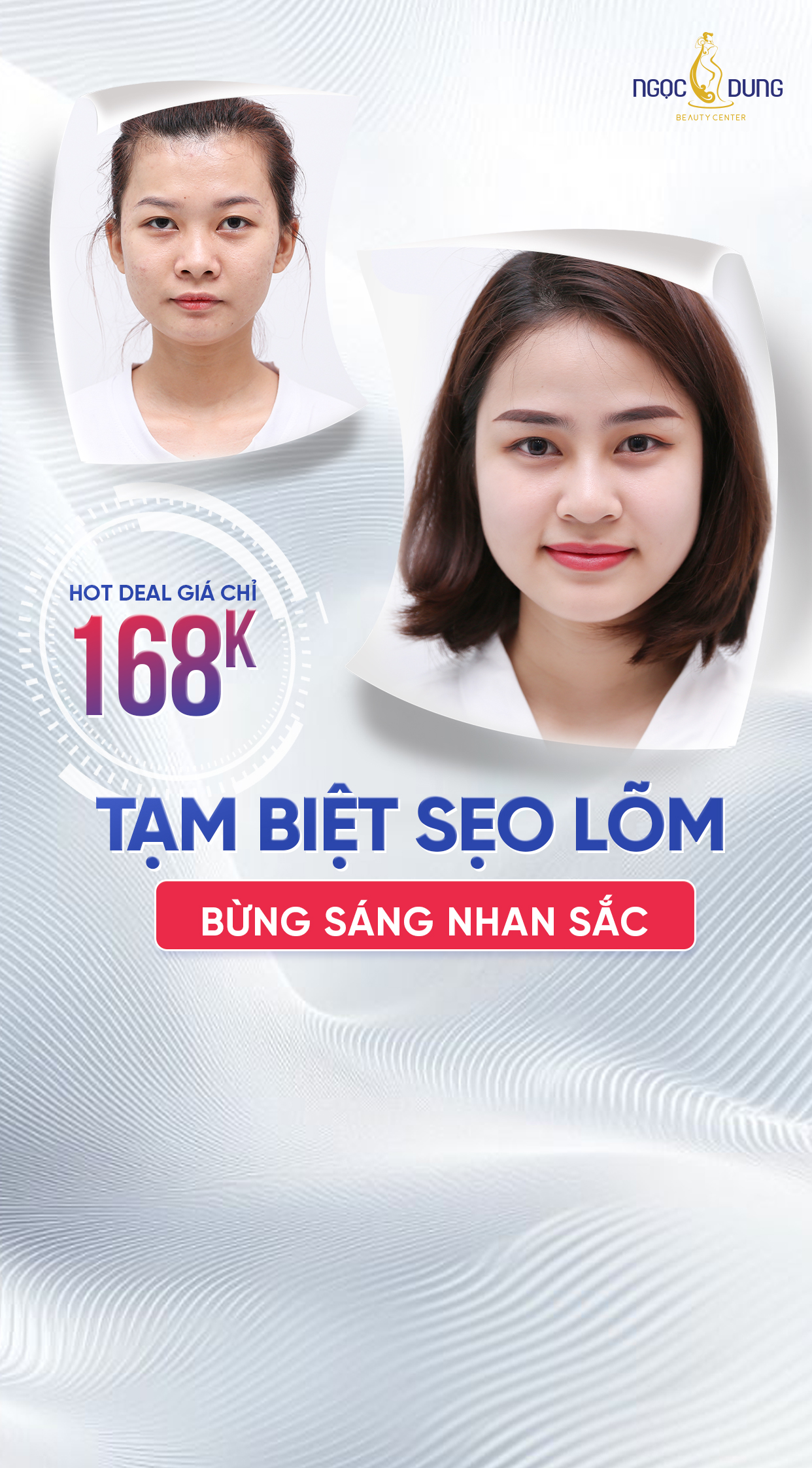 ưu đãi trị sẹo lõm mobile