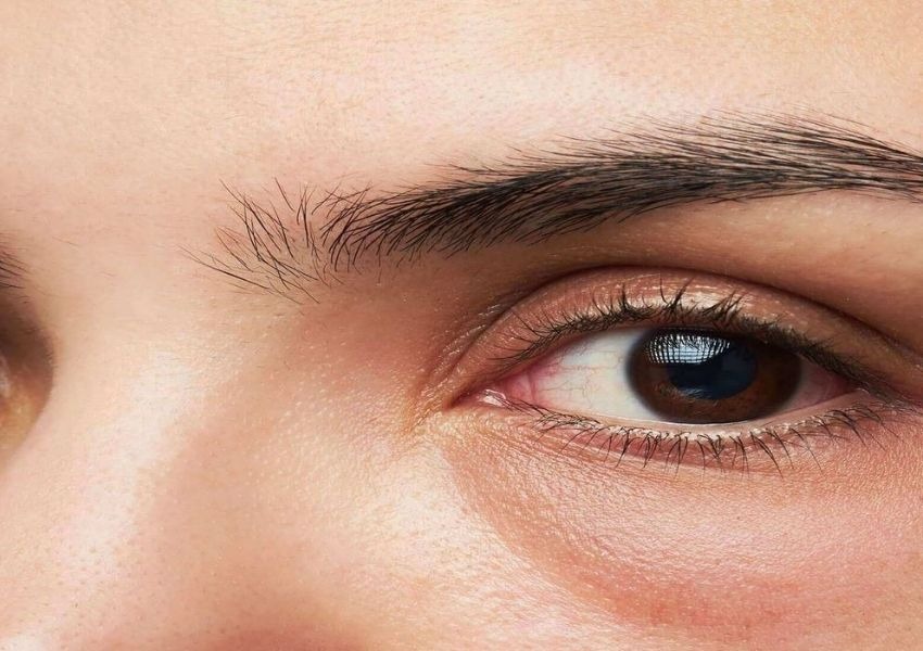 Cách trị bọng mắt bằng muối tại nhà hiệu quả, an toàn 8 Bọng mắt khiến gương mặt kém sắc hơn