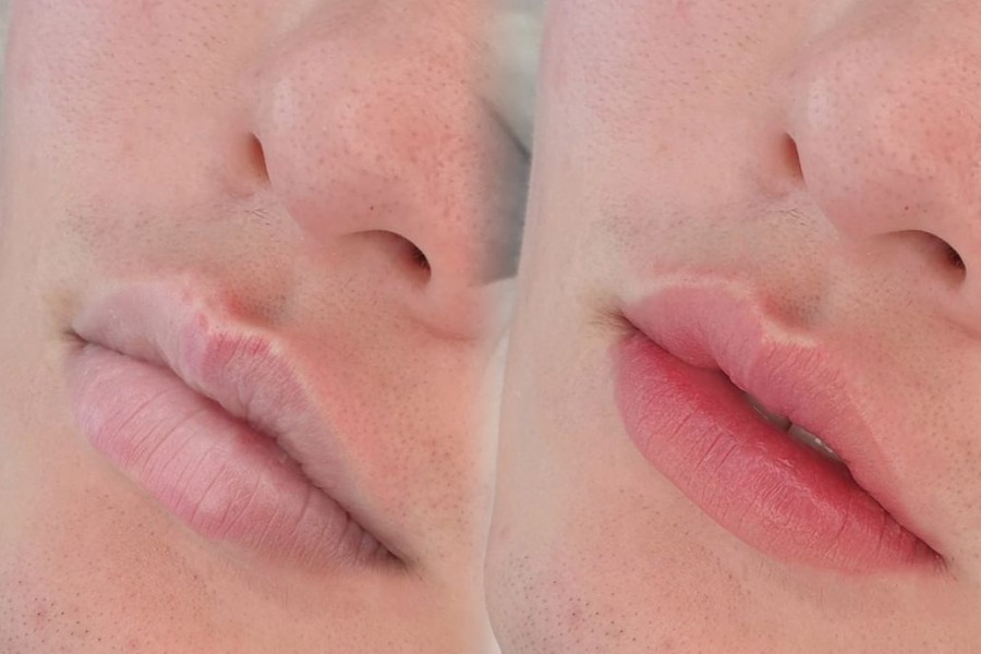 Khử thâm môi là phương pháp làm đẹp được nhiều người lựa chọn