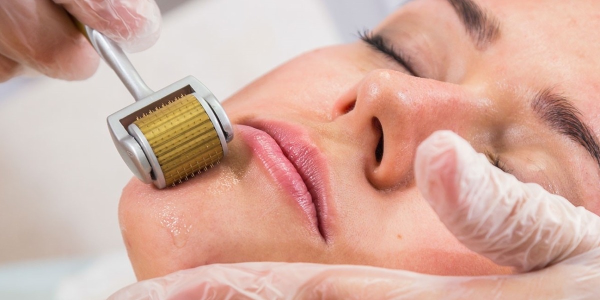 Liệu trình lăn kim vi điểm giúp mờ thâm hiệu 