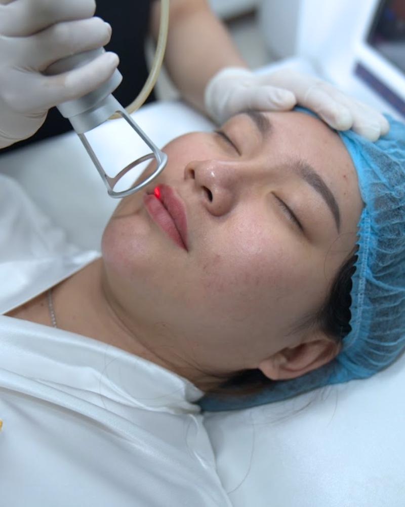 tien hanh xoa xam moi 1