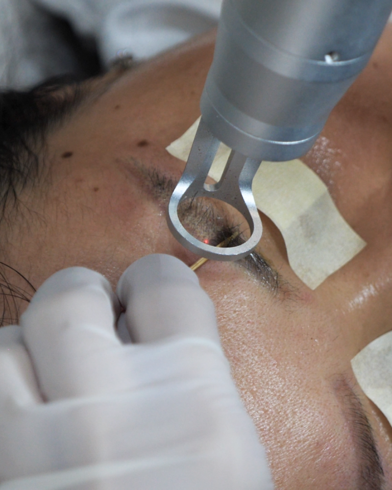 tien hanh xoa xam tham my